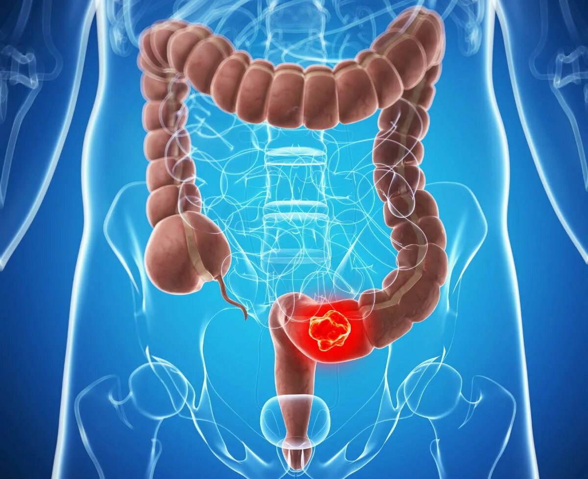 Опухоль Толстого кишечника. Злокачественная опухоль толстой кишки. Онкология толстой кишки.