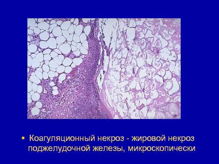 Некроз поджелудочной железы гистология. Коагуляционный некроз патанатомия. Поджелудочная железа при муковисцидозе микропрепарат. Жировая инфильтрация поджелудочной. Жировой панкреонекроз гистология.