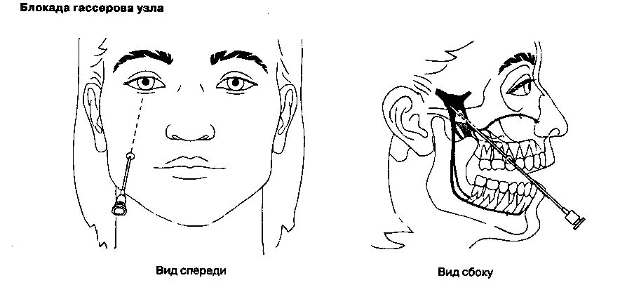 Блокада тройничного. Блокада 3 ветви тройничного нерва техника выполнения. Схема блокады ветвей тройничного нерва. Схема блокады тройничного нерва. Блокада 1 ветви тройничного нерва.