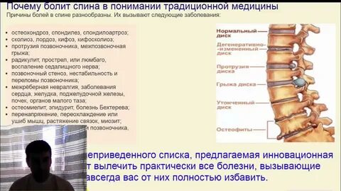 Межпозвоночная невралгия