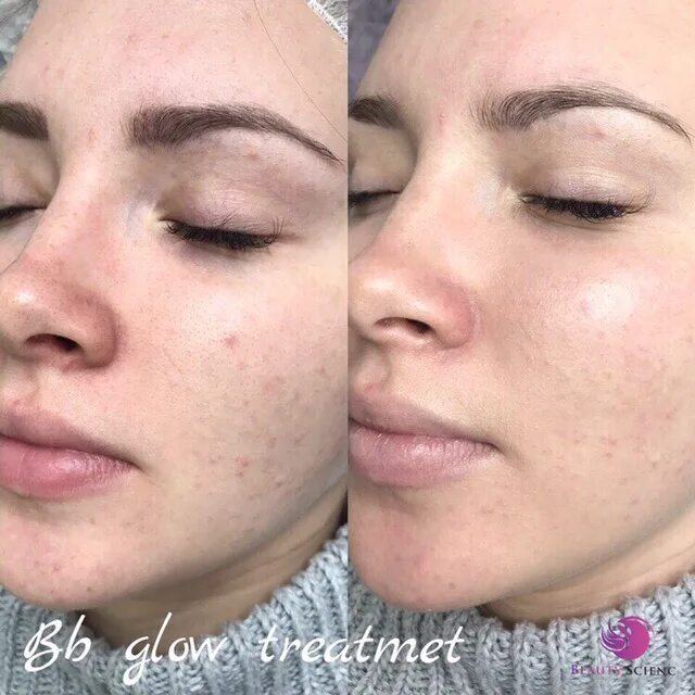 Бб глоу эффект тонального крема. Bb glow для лица. Вв глоу процедура. Бб глоу. Эффект бб глоу.
