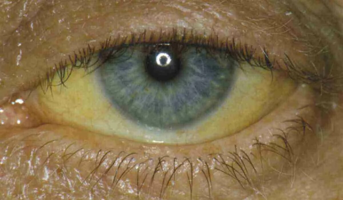 Желтые глаза печень