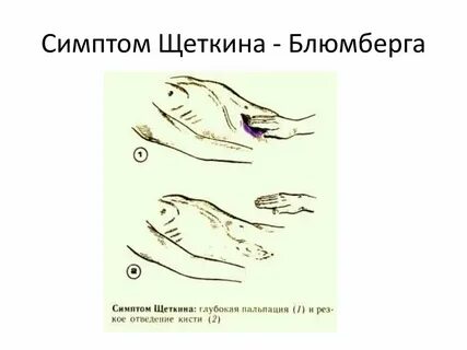 Пальпация при остром животе