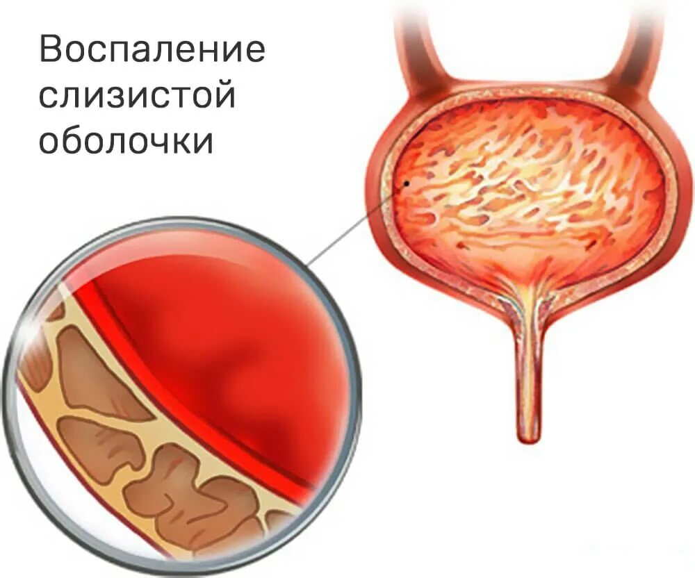 Жжение в головке после мочеиспускания. Цистит это воспаление слизистой оболочки мочевого пузыря. Цистит мочевого пузыря у животных. Инфекция мочевого пузыря (цистит);. Цистит восполениемочевого пузыря.