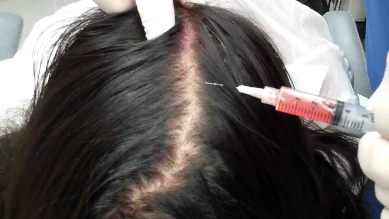 Инъекции головы. Мезотерапия кожи головы. Плазмолифтинг кожи головы. Мезотерапия для волос. Уколы для волос.