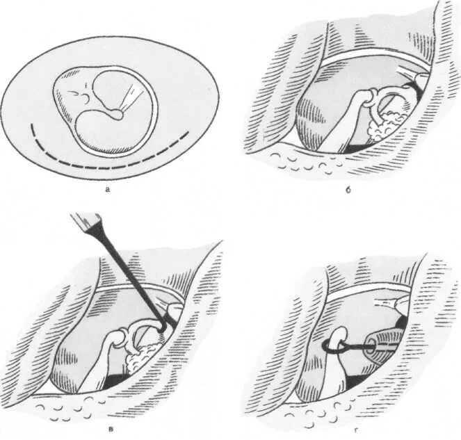 Отосклероз уха операция. Стапедопластика этапы операции. Стапедопластика поршневая методика. Отосклероз операция стапедопластика.