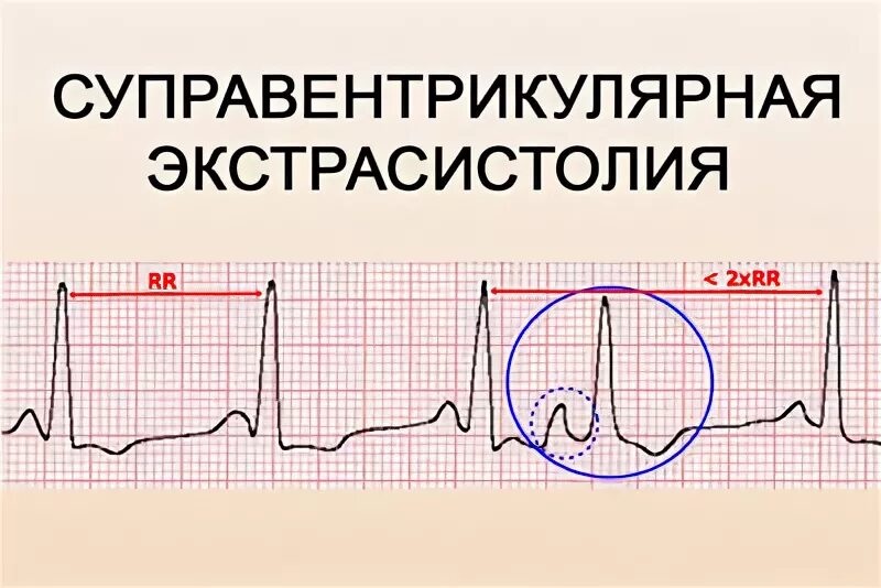 Наджелудочковые экстрасистолы на ЭКГ. Наджелудочковая экстрасистолия на ЭКГ. Суправентрикулярная экстрасистолия на ЭКГ. Одиночная наджелудочковая экстрасистолия на ЭКГ. Экстрасистолы врачам