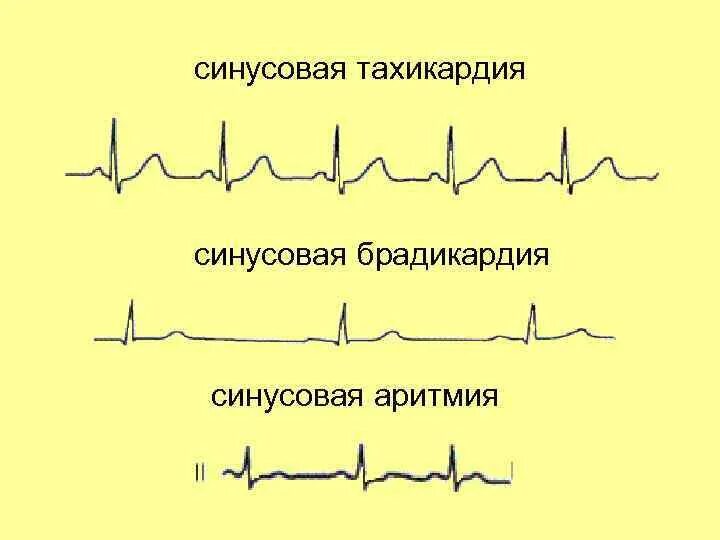 экг при минусовой тахиаритмии. тахикардия при синусовом ритме. что значит синусовая тахикардия. что значит синусовая тахикардия. ритм синусовая тахикардия 100 уд/мин.