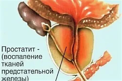 Воспалился простатит. Воспаление при простатите. Воспаление предстательной железы у женщин. Другие воспалительные процессы предстательной железы.