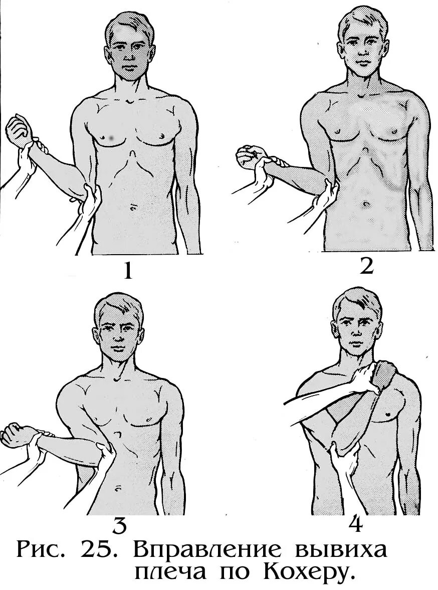 Лечение плеча после вправления. Вправление вывиха методом кохера. Вправления вывиха плеча по методу кохера. Вывих плечевого сустава вправление самостоятельно. Метод вправления вывиха плечевого сустава?.