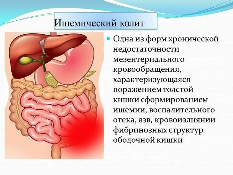 Колика при колите. Хроническая ишемия кишечника. Ишемический колит симптомы. Хроническая ишемическая болезнь органов пищеварения.