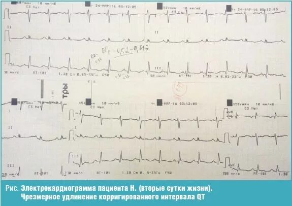 Удлинение корригированного интервала qt свыше