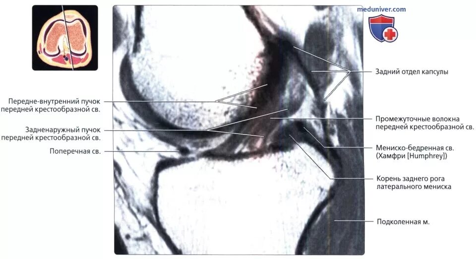 Менисцит медиального мениска. Мениско бедренная связка мрт. Менисцит коленного сустава мрт. Повреждение медиального мениска коленного сустава мрт.