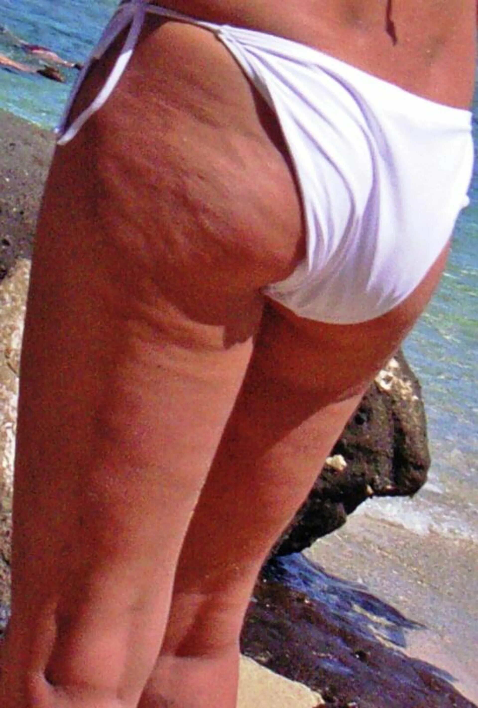 Липодистрофия целлюлит. Русский целлюлит. Рози хантингтон целлюлит. Русский целлюлит. Русский целлюлит.