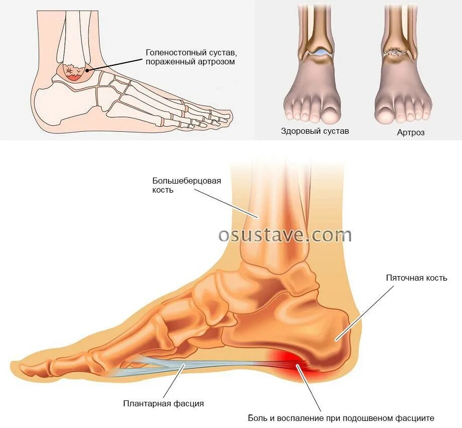 Голеностопный сустав. Голеностоп сустав. Каналы голеностопного сустава. Боль в голеностопном суставе.