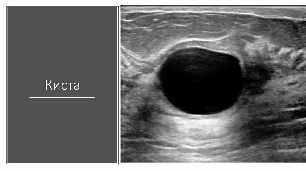 Как отличить кисту. Атипическая киста молочной железы. Трихолеммальная киста. Киста молочной железы УЗИ снимок. Протоковые кисты молочной железы.