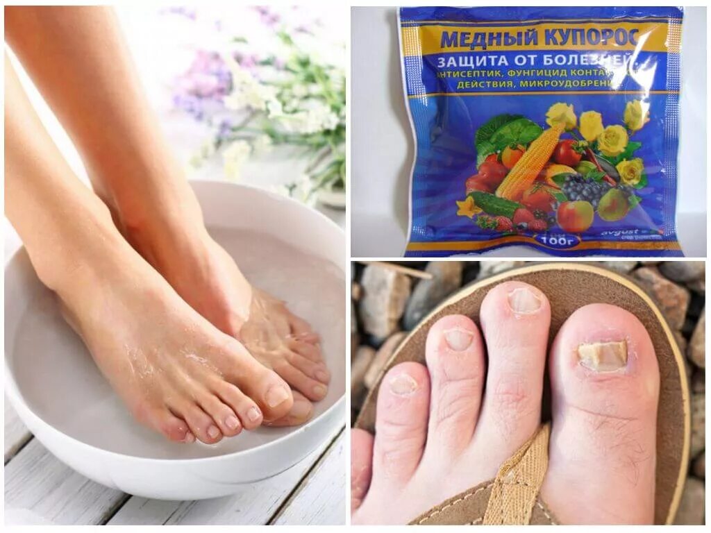 Ванночки для ног от грибка на ногтях. Грибок ногтей на подошве ног. Можно избавиться от грибка ногтей