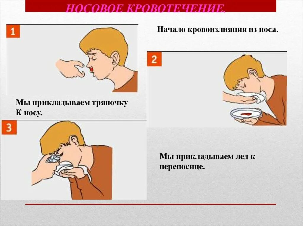 Оказание первой помощи при носовом кровотечении. Оказание помощи при кровотечении из носа.