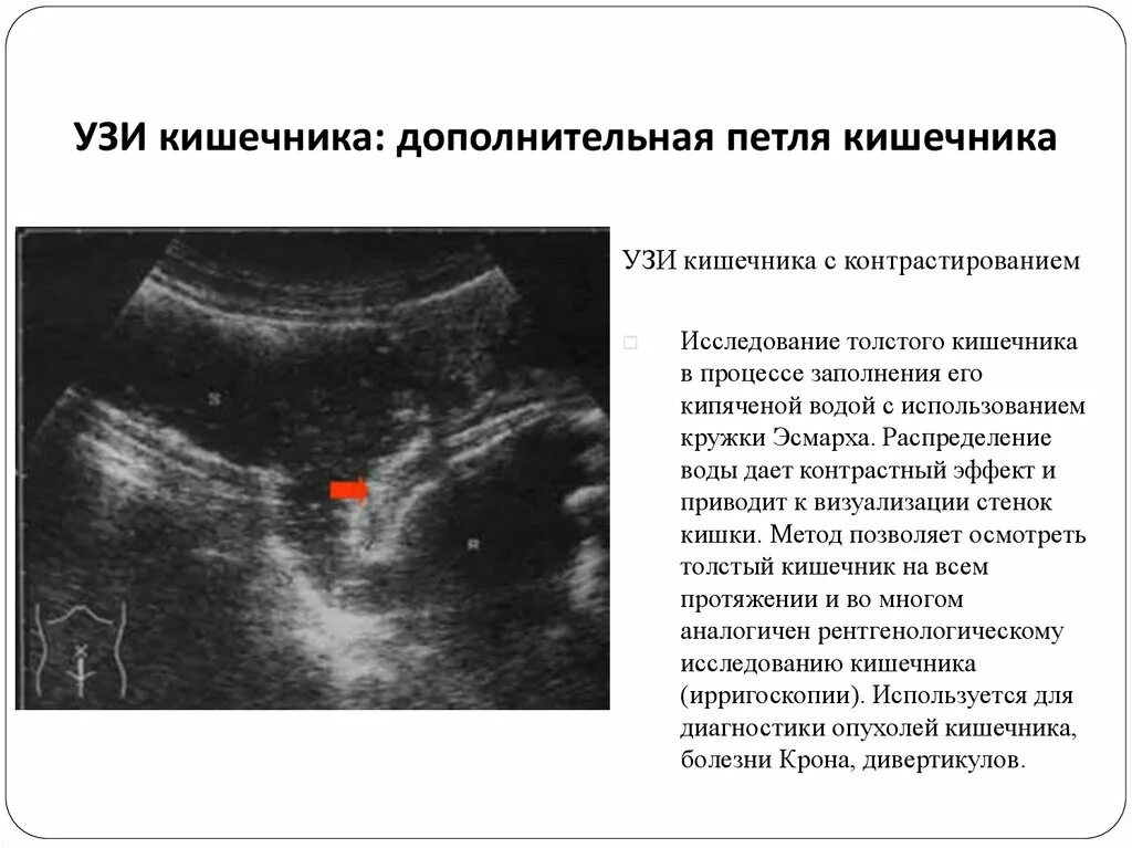 УЗИ Толстого кишечника при патологии. УЗИ кишечника (эндоректальная ультрасонография). Ультразвуковое исследование при острой кишечной непроходимости. Узи кишечника как подготовиться