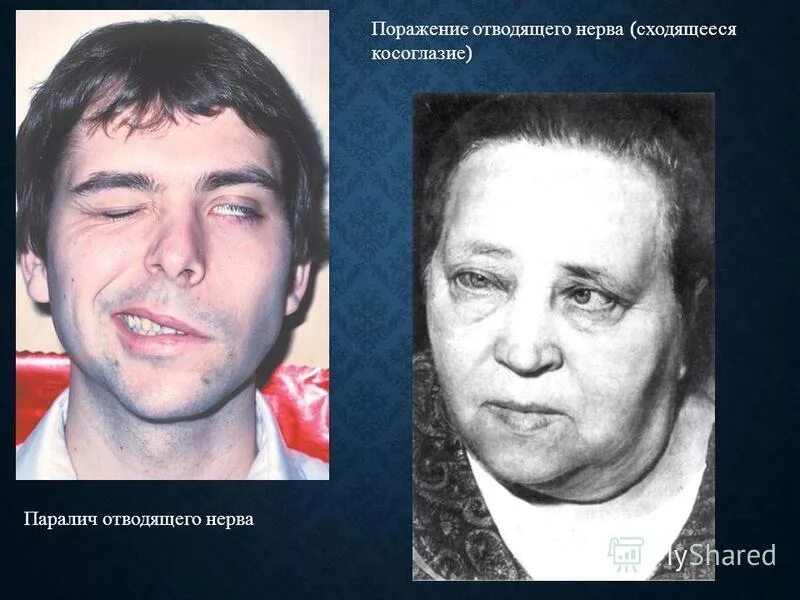 Парез отводящего. Паралич отводящего нерва. отводящий нерв сходящееся косоглазие. ядерный паралич отводящего нерва. паралич левого отводящего нерва.