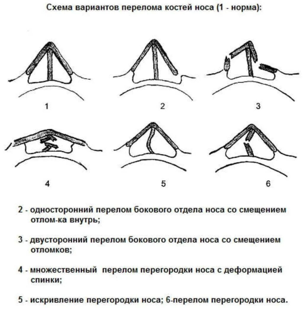 Переломы костей носа классификация. Признаки перелома носовой кости. Признаки закрытого перелома носа. Открытый перелом костей носа со смещением отломков..