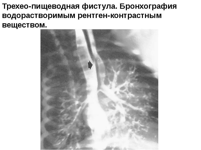Бронхография дыхательная системы. Контрастная бронхография. Бронхоскопия и бронхография. Контрастная бронхография. Бронхоэктатическая болезнь бронхография.