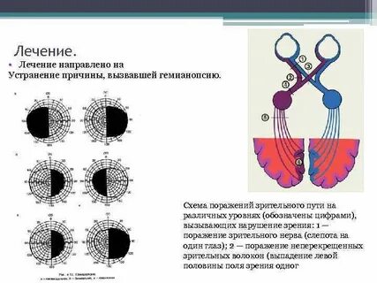 Поражение зрительных путей
