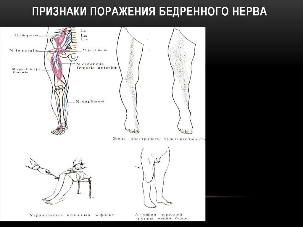 Поражение нервов нижних конечностей. Нейропатия бедренного нерва симптомы. Неврит бедренного нерва (болезнь рота-Бернгардта). Парез бедренного нерва симптомы. Бедренный нерв симптомы поражения.