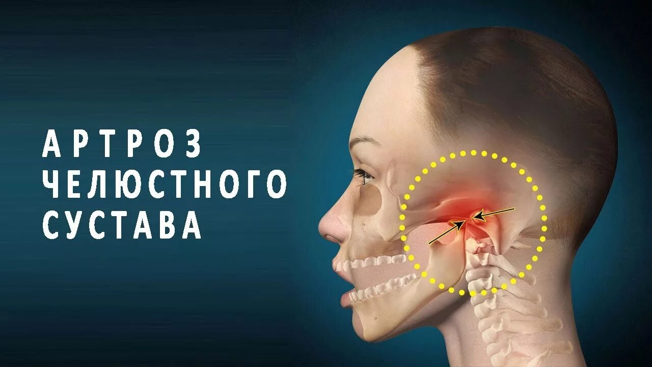 Почему может болеть челюсть. Челюстно височный сустав. Челбтно вислчный сумстав. Височно челюстной сустав.