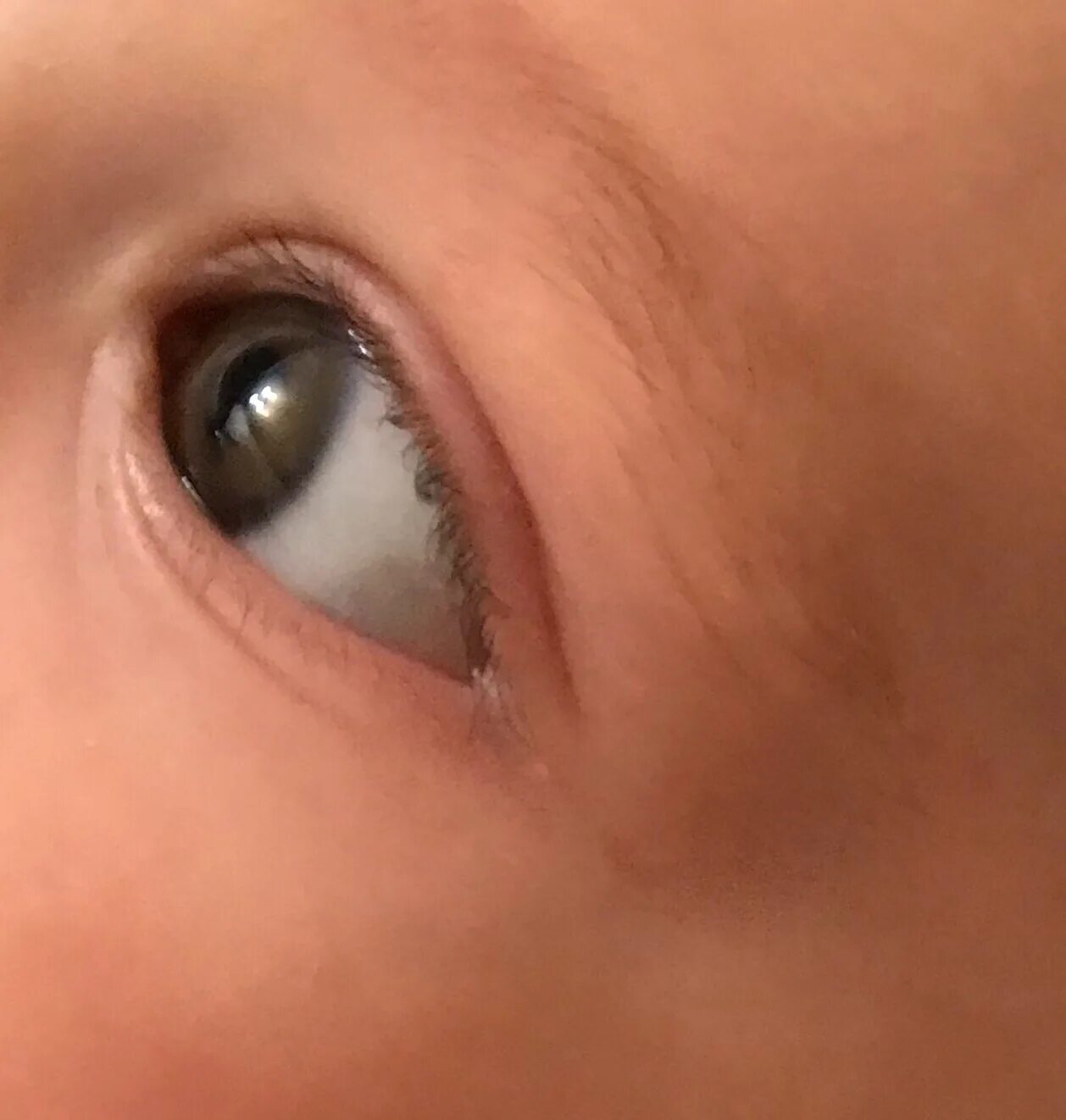 Почему у новорожденного глазки. Меланоз склеры гиперметропия. Серые белки глаз у грудничка. Глаза грудничка. Темное пятно на белке глаза.