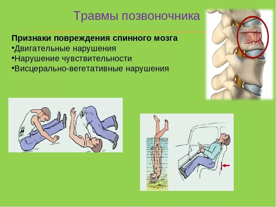 Сотрясение позвоночника. Признаки повреждения позвоночника. Поврежденияпозвоночник. Признаки травмы позвоночника.