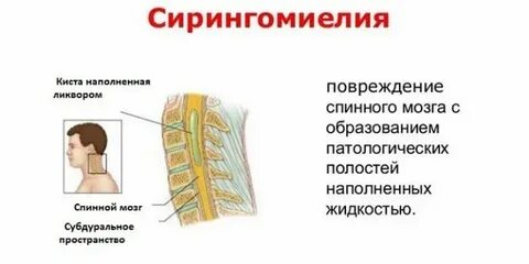 Неврологическое заболевание спинного мозга