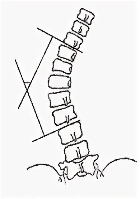 Классификация Кобба сколиоз. Угол Кобба 1 степени сколиоза. Метод Кобба сколиоз рентген. Сколиоз позвоночника по чаклину. Угол кобба