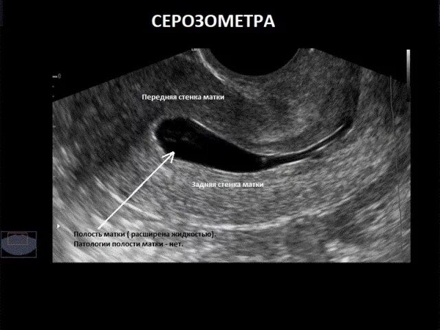 Матка расширена что это значит. Полип эндометрия в матке на УЗИ. Серозометра эндометрия.