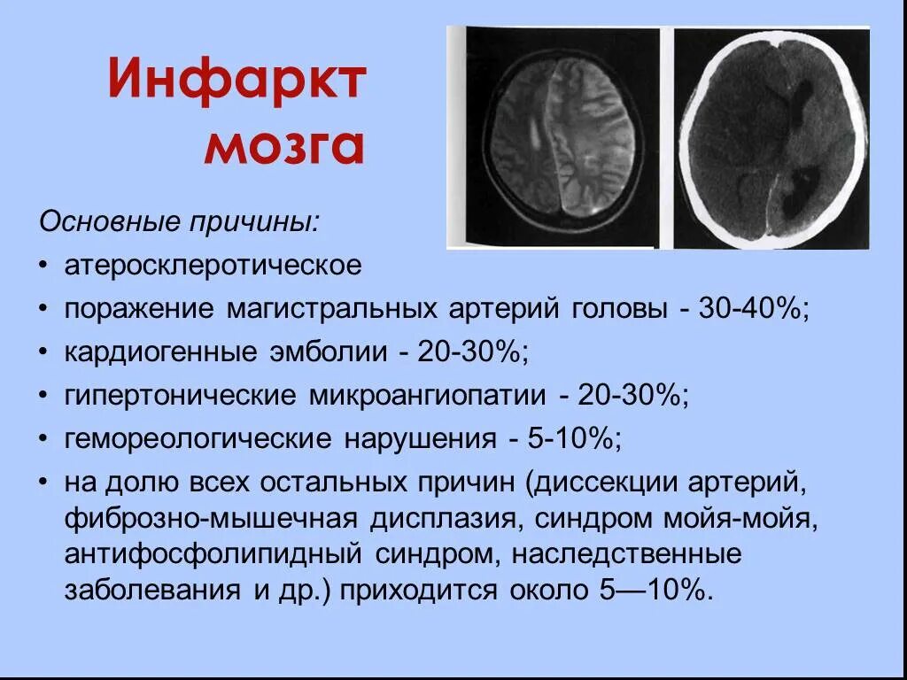 Инфаркт мозга неуточненный. Инфарктголовногомозка. Инфаркт головного мозга причины. Ишемический инфаркт головного мозга.