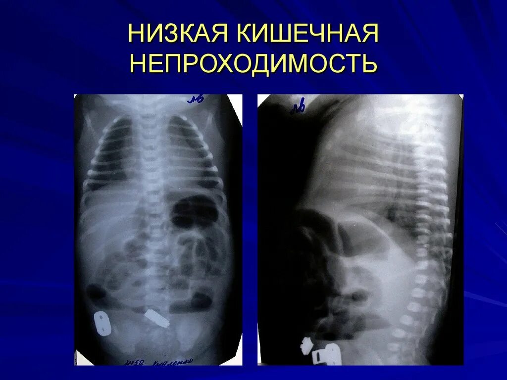 Частичная непроходимость кишечника. Врожденная кишечная непроходимость рентген. спаечная непроходимость рентген. обтурационная кишечная непроходимость рентген. врожденная низкая кишечная непроходимость рентген.