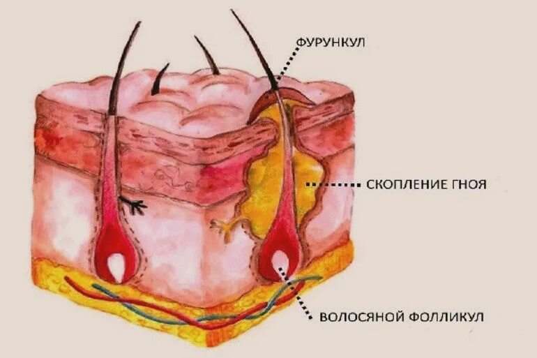 Как лечить абсцесс. Фурункул карбункул абсцесс. фурункул фурункулез карбункул.