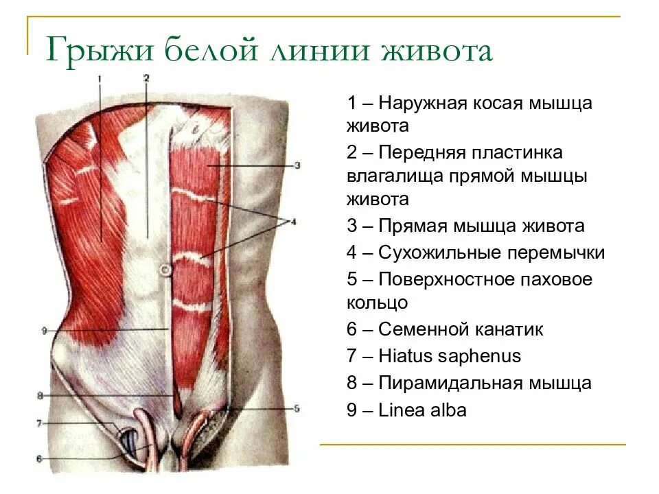 Грыжа прямой мышцы