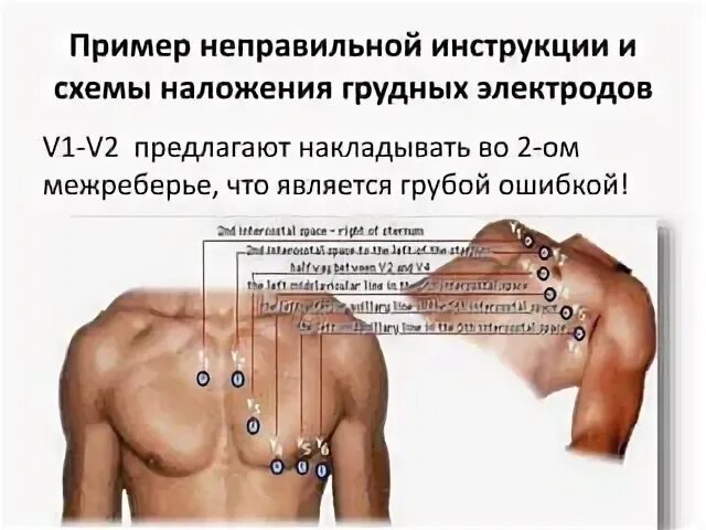 Наложение электродов при экг схема по цветам