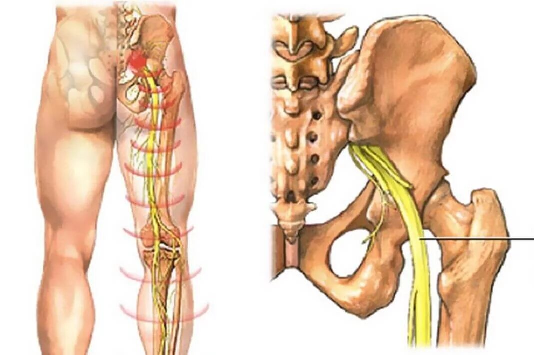 Боли в пояснице защемление нерва лечение. Седалищный нерв кровоснабжается. Нейропатия седалищного нерва. Седалищный нерв крестец. Седалищный нерв л5 с1.