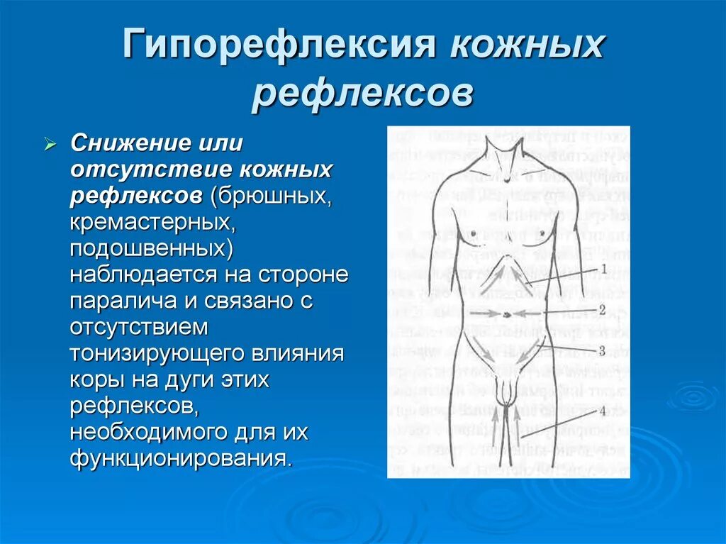 Кожные брюшные рефлексы. Поверхностные брюшные рефлексы. Брюшные рефлексы отсутствуют. Исследование брюшных рефлексов.