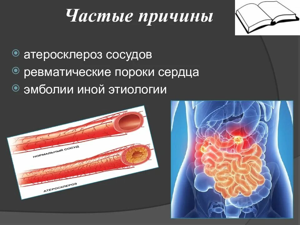 Ишемия сосудов симптомы. Мезентериальные сосуды атеросклероз. Симптом атеросклероза мезентериальных артерий. Атеросклероз мезентериальных сосудов симптомы. Атеросклероз сосудов сердца этиология.