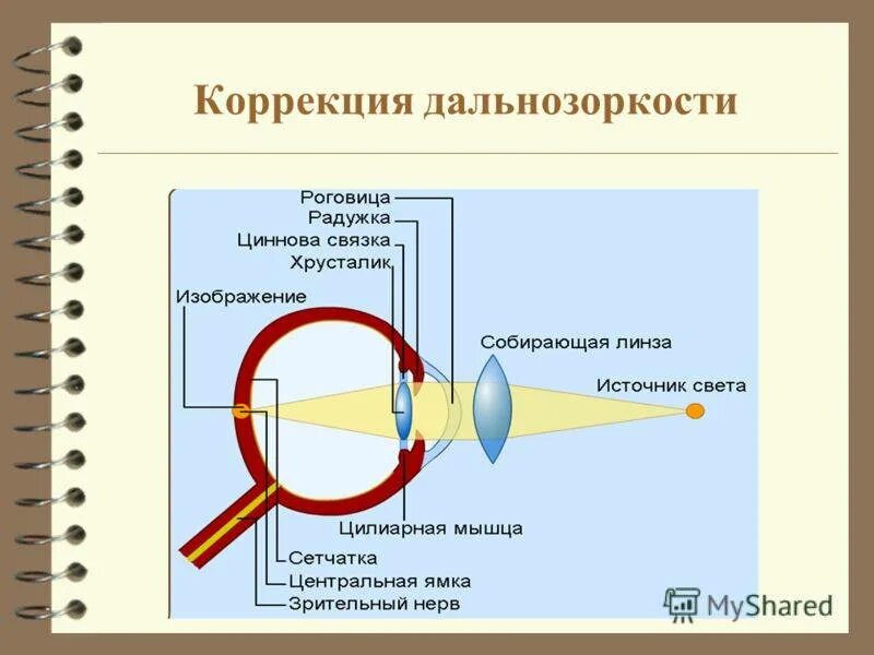 Причины возникновения дальнозоркости. Близорукость и дальнозоркость физика 11 класс. Дальнозоркость и близорукость презентация. Дальнозоркость сообщение по биологии. Основная причина дальнозоркости.