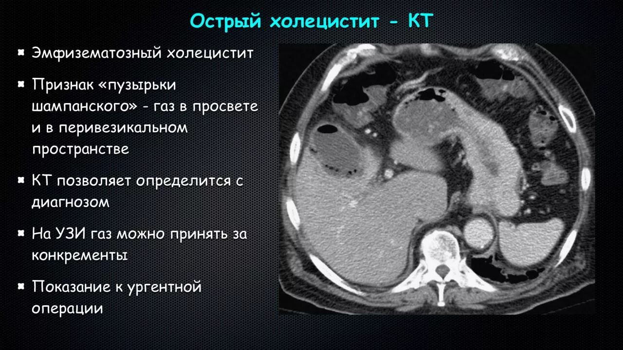 Диагноз калькулезный холецистит. Конкременты желчного пузыря на кт. Эмфизематозный холецистит на кт.