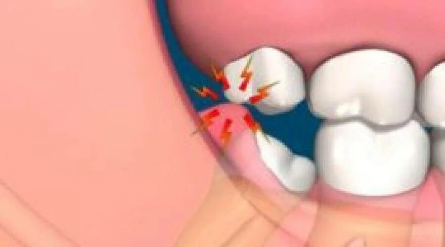 Опухла десна у мудрого зуба. Десна на зубе у ребенка что делать. Десна на зубе у ребенка что делать. Десна на зубе у ребенка что делать. Десна на зубе у ребенка что делать.