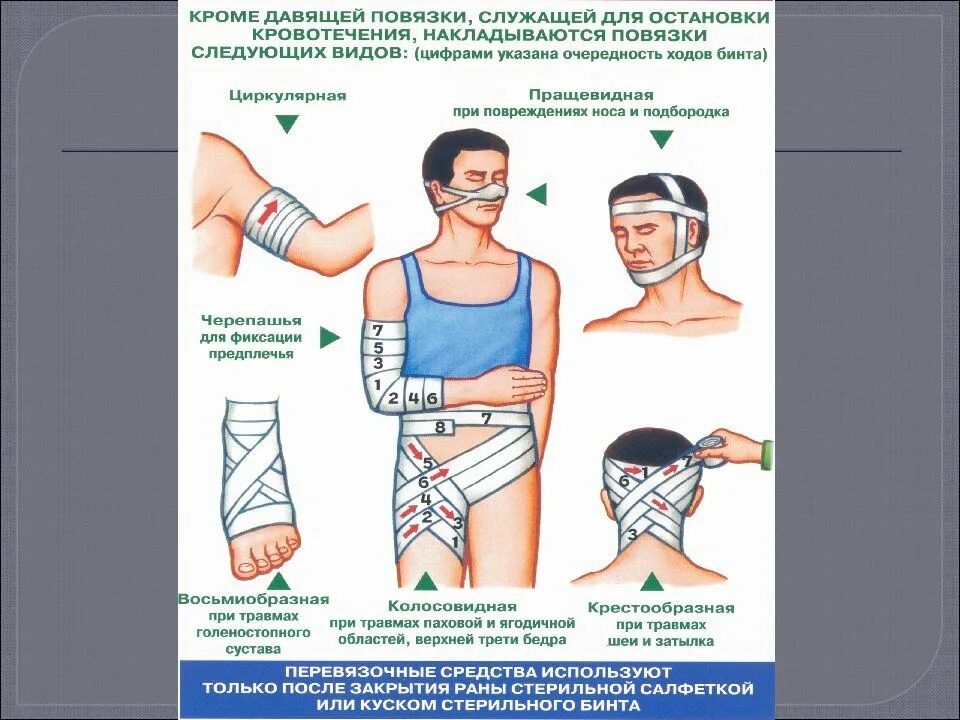 Остановка кровотечения наложение повязки. Наложение повязок при ранениях и кровотечениях. Наложение повязки при ранении.