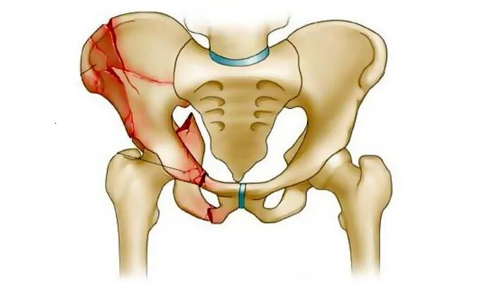 Разрыв кости. Подвздошная кость перелом. Перелом гребня подвздошной кости. Лонная кость таза перелом анатомия. Лонная кость таза.