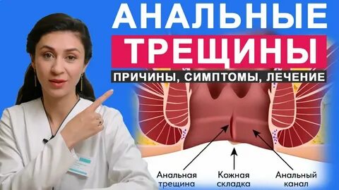 Геморрой трещина заднего прохода