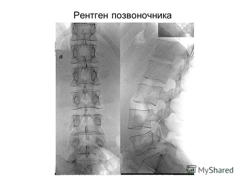 Поясничный отдел позвоночника рентген норма. Поясничный отдел позвоночника рент. Степени сколиоза поясничного отдела позвоночника рентген. Рентген пояснично-крестцового отдела остеохондроз. Рентгенкартина после гранулотека.