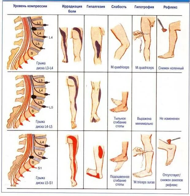 Боль в спине отдает в левую ногу. Радикулопатия s1 корешка. Позвоночник ноги.